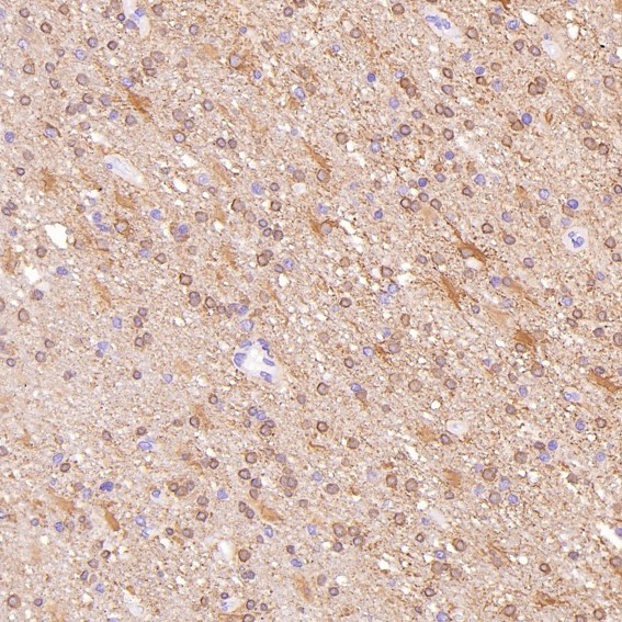 Immunohistochemical analysis of paraffin-embedded Human glioblastoma, using the Antibody at 1:250 dilution