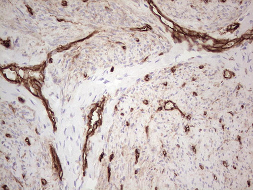 Immunohistochemical staining of paraffin-embedded Adenocarcinoma of Human endometrium tissue using anti-ENTPD1 mouse monoclonal antibody