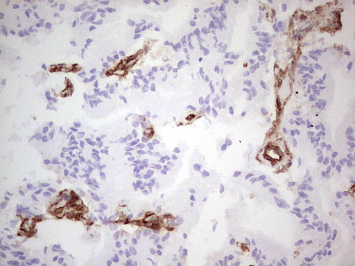 Immunohistochemical staining of paraffin-embedded Carcinoma of Human prostate tissue using anti-ENTPD1 mouse monoclonal antibody