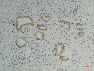 Immunohistochemical analysis of paraffin-embedded Human Pancreatic Carcinoma using Cyclophilin BMouse mAb diluted at 1:200
