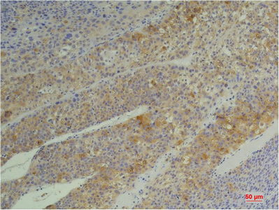 Immunohistochemical analysis of paraffin-embedded Human Heptacarcinoma using Cyclophilin BMouse mAb diluted at 1:200