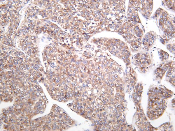 Human hepatocellular carcinoma was stained with anti-CaMKII α rabbit antibody