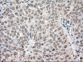 Immunohistochemical staining of paraffin-embedded Adenocarcinoma of Human ovary tissue using anti-ACAT2 mouse monoclonal antibody