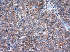 Immunohistochemical staining of paraffin-embedded Adenocarcinoma of Human ovary tissue using anti-ACAT2 mouse monoclonal antibody