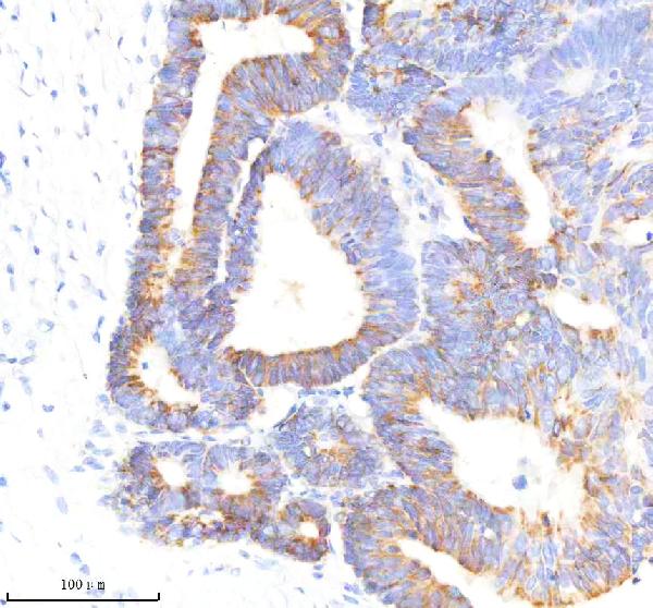 Figure 2. IHC analysis of GLUT3/SLC2A3 using anti-GLUT3/SLC2A3 antibody (M03259). GLUT3/SLC2A3 was detected in a paraffin-embedded section of human colon cancer tissue. Heat mediated antigen retrieval was performed in EDTA buffer (pH 8.0, epitope retrieval solution). The tissue section was blocked with 10% goat serum. The tissue section was then incubated with 1:200 rabbit anti-GLUT3/SLC2A3 Antibody (M03259) overnight at 4°C. Peroxidase Conjugated Goat Anti-rabbit IgG was used as secondary antibody and incubated for 30 minutes at 37°C. The tissue section was developed using HRP Conjugated Rabbit IgG Super Vision Assay Kit (Catalog # SV0002) with DAB as the chromogen.