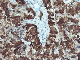 Immunohistochemical staining of paraffin-embedded Adenocarcinoma of Human ovary tissue using anti-CRABP2 mouse monoclonal antibody