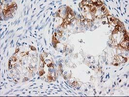 Immunohistochemical staining of paraffin-embedded Adenocarcinoma of Human ovary tissue using anti-BAIAP2 mouse monoclonal antibody