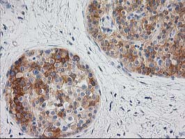Immunohistochemical staining of paraffin-embedded Carcinoma of Human pancreas tissue using anti-BAIAP2 mouse monoclonal antibody
