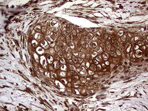 Immunohistochemical staining of paraffin-embedded Carcinoma of Human bladder tissue using anti-CLCA1 mouse monoclonal antibody