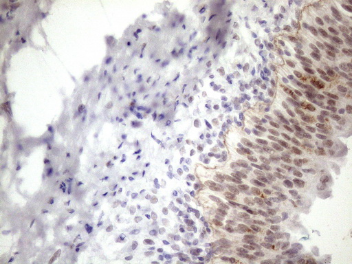 Immunohistochemical staining of paraffin-embedded Carcinoma of Human prostate tissue using anti-ESRRA mouse monoclonal antibody