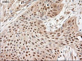 Immunohistochemical staining of paraffin-embedded Carcinoma of lung using anti-NTF3 (M03348) mouse monoclonal antibody (Heat-induced epitope retrieval by 10mM citric buffer