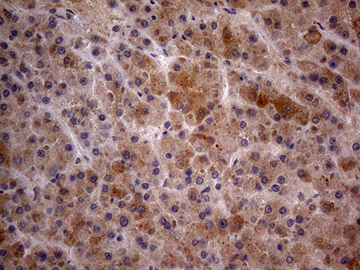 Immunohistochemical staining of paraffin-embedded Carcinoma of Human liver tissue using anti-GC mouse monoclonal antibody