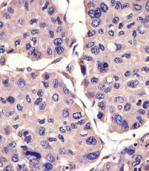 M03372 staining CANX in human hepatocarcinoma sections by Immunohistochemistry (IHC-P -paraformaldehyde-fixed, paraffin-embedded sections)