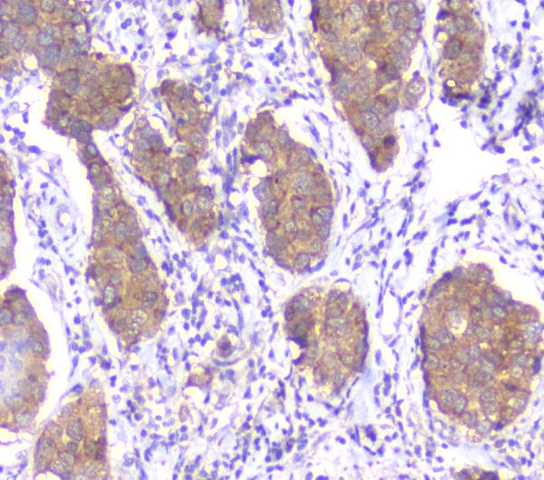 IHC analysis of SMN1/2 using anti-SMN1/2 antibody (M03420-1). SMN1/2 was detected in paraffin-embedded section of human mammary cancer tissue. Heat mediated antigen retrieval was performed in citrate buffer (pH6, epitope retrieval solution) for 20 mins. The tissue section was blocked with 10% goat serum. The tissue section was then incubated with 1μg/ml mouse anti-SMN1/2 Antibody (M03420-1) overnight at 4°C. Biotinylated goat anti-mouse IgG was used as secondary antibody and incubated for 30 minutes at 37°C. The tissue section was developed using Strepavidin-Biotin-Complex (SABC)(Catalog # SA1021) with DAB as the chromogen.
