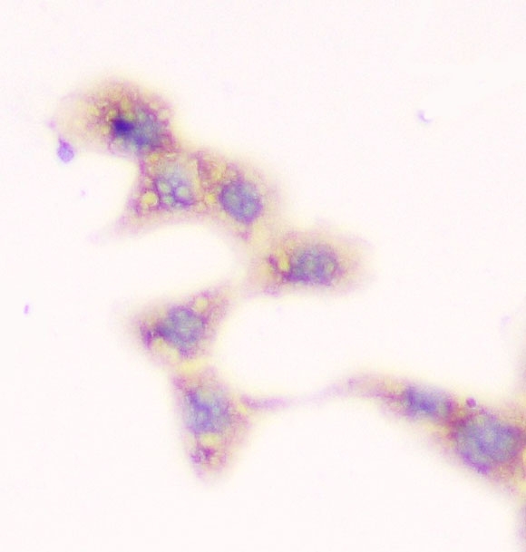 IHC analysis of SMN1/2 using anti-SMN1/2 antibody (M03420-1). SMN1/2 was detected in immunocytochemical section of A431 cell. Enzyme antigen retrieval was performed using IHC enzyme antigen retrieval reagent (AR0022) for 15 mins. The cells were blocked with 10% goat serum. And then incubated with 1μg/ml mouse anti-SMN1/2 Antibody (M03420-1) overnight at 4°C. Biotinylated goat anti-mouse IgG was used as secondary antibody and incubated for 30 minutes at 37°C. The section was developed using Strepavidin-Biotin-Complex (SABC)(Catalog # SA1021) with DAB as the chromogen.