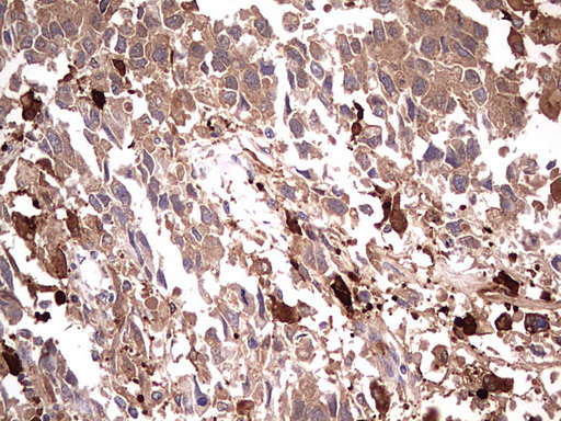 Immunohistochemical staining of paraffin-embedded Adenocarcinoma of Human ovary tissue using anti-TRIM27 mouse monoclonal antibody. (Heat-induced epitope retrieval by 1 mM EDTA in 10mM Tris