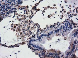 Immunohistochemical staining of paraffin-embedded Carcinoma of Human lung tissue using anti-CYB5R3 mouse monoclonal antibody