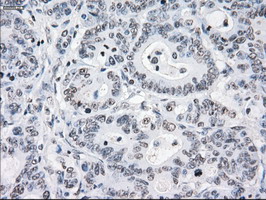 Immunohistochemical staining of paraffin-embedded Adenocarcinoma of Human colon tissue using anti-CRYAB mouse monoclonal antibody