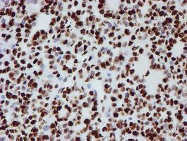 Immunohistochemical staining of paraffin-embedded Carcinoma of Human thyroid tissue using anti-NONO mouse monoclonal antibody