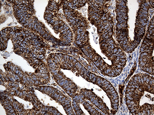 Immunohistochemical staining of paraffin-embedded Adenocarcinoma of Human endometrium tissue using anti-CYP7B1 mouse monoclonal antibody