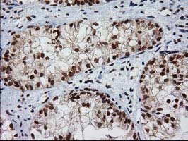 Immunohistochemical staining of paraffin-embedded Adenocarcinoma of Human ovary tissue using anti-NHEJ1 mouse monoclonal antibody