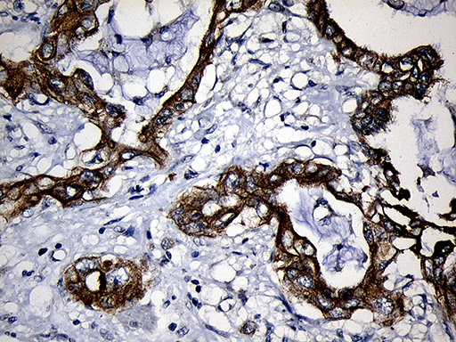 Immunohistochemical staining of paraffin-embedded Carcinoma of Human pancreas tissue using anti-CPT1B mouse monoclonal antibody