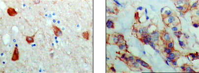 Immunohistochemistry analysis of paraffin-embedded human brain (left) and breast carcinoma (right), showing cytoplasmic and membrane localization with DAB staining using PAR4 Monoclonal Antibody