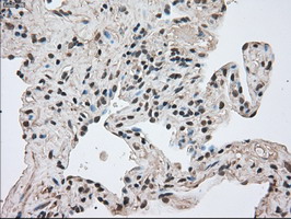Immunohistochemical staining of paraffin-embedded Carcinoma of Human lung tissue using anti-FERMT2 mouse monoclonal antibody