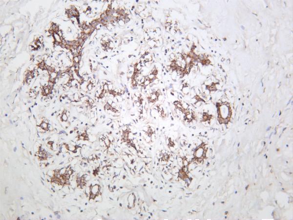 Human breast carcinoma was stained with anti-ACACB rabbit antibody
