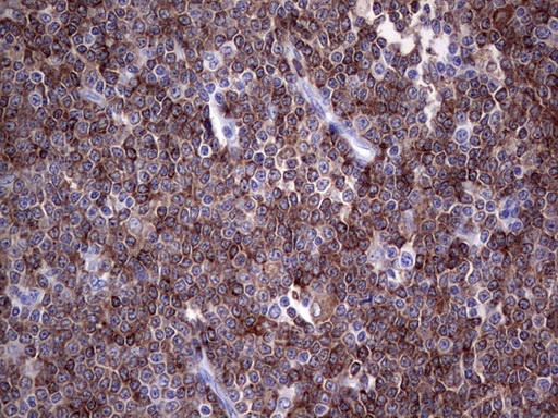 Immunohistochemical staining of paraffin-embedded Human lymphoma tissue using anti-TFPI2 mouse monoclonal antibody