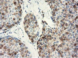 Immunohistochemical staining of paraffin-embedded Adenocarcinoma of Human breast tissue using anti-GSTA4 mouse monoclonal antibody at 1:150 (M03699)