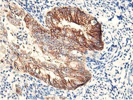 Immunohistochemical staining of paraffin-embedded Adenocarcinoma of Human endometrium tissue using anti-RBBP7 mouse monoclonal antibody