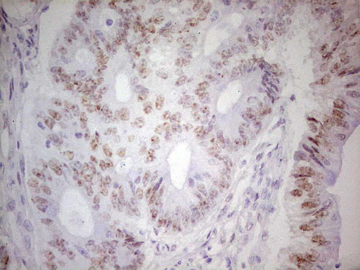 Immunohistochemical staining of paraffin-embedded Adenocarcinoma of Human colon tissue using anti-TRIB1 mouse monoclonal antibody