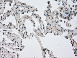 Immunohistochemical staining of paraffin-embedded Carcinoma of Human lung tissue using anti-NEK6 mouse monoclonal antibody