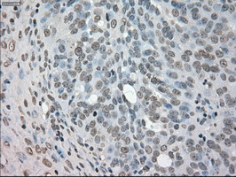 Immunohistochemical staining of paraffin-embedded Adenocarcinoma of Human ovary tissue using anti-NEK6 mouse monoclonal antibody