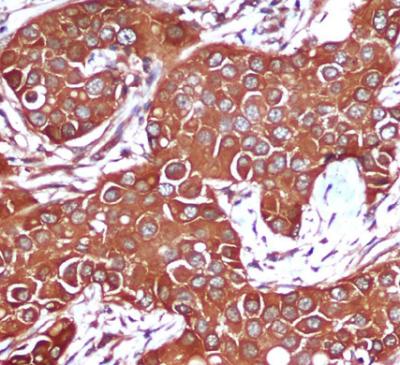 Immunohistochemical analysis of paraffin-embedded Breast cancer using AMPKβ1 mouse mAb (1/200 dilution)
