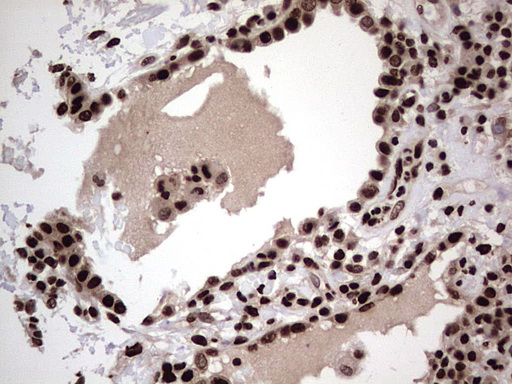 Immunohistochemical staining of paraffin-embedded Carcinoma of Human lung tissue using anti-HNRNPL mouse monoclonal antibody