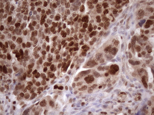 Immunohistochemical staining of paraffin-embedded Adenocarcinoma of Human ovary tissue using anti-KLF9 mouse monoclonal antibody