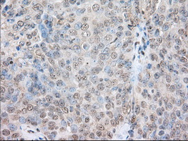 Immunohistochemical staining of paraffin-embedded Adenocarcinoma of Human ovary tissue using anti-SNX9 mouse monoclonal antibody