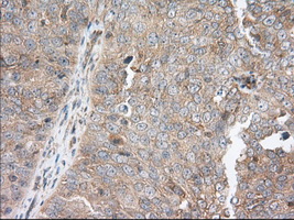 Immunohistochemical staining of paraffin-embedded Adenocarcinoma of Human ovary tissue using anti-SNX9 mouse monoclonal antibody