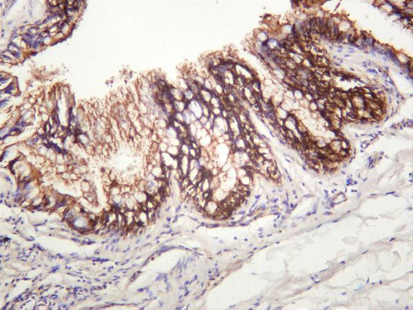 Human colon carcinoma was stained with anti-ITGB6 rabbit antibody