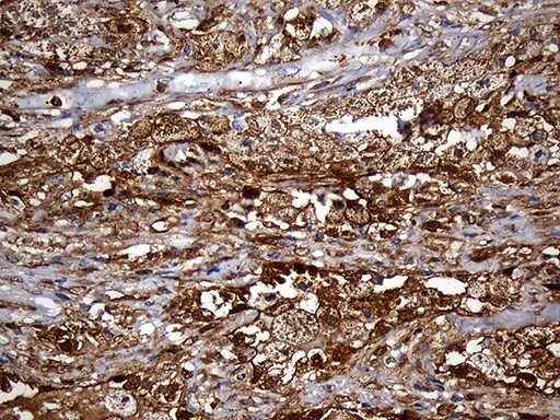 Immunohistochemical staining of paraffin-embedded Carcinoma of Human lung tissue using anti-SULT1A3 mouse monoclonal antibody