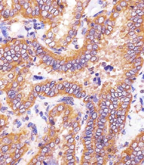 M03844-1 staining HSD17B10 in human thyroid carcinoma sections by Immunohistochemistry (IHC-P -paraformaldehyde-fixed, paraffin-embedded sections)