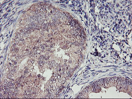 Immunohistochemical staining of paraffin-embedded Adenocarcinoma of Human endometrium tissue using anti-TMEFF2 mouse monoclonal antibody