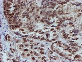 Immunohistochemical staining of paraffin-embedded Adenocarcinoma of Human ovary tissue using anti-ATRIP mouse monoclonal antibody