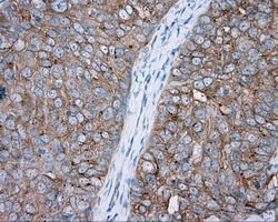 Immunohistochemical staining of paraffin-embedded Adenocarcinoma of ovary tissue using anti-PRKAR2A mouse monoclonal antibody