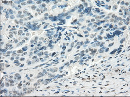 Immunohistochemical staining of paraffin-embedded Adenocarcinoma of ovary tissue using anti-FOSL1mouse monoclonal antibody