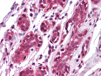 Immunohistochemistry analysis of paraffin-embedded human Breast tissues with AEC staining using EphA7 Monoclonal Antibody