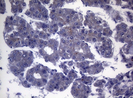 Immunohistochemical staining of paraffin-embedded Carcinoma of Human liver tissue using anti-CEP55 mouse monoclonal antibody