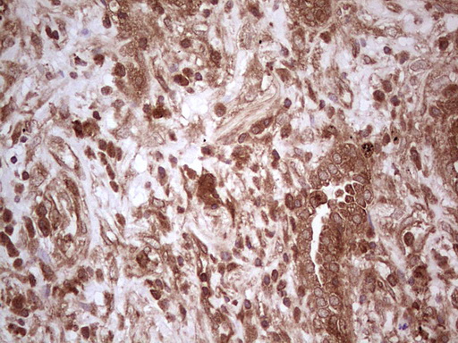 Immunohistochemical staining of paraffin-embedded Carcinoma of Human lung tissue using anti-UBE2D2 mouse monoclonal antibody